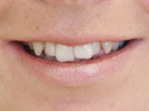 Mikala before Invisalign